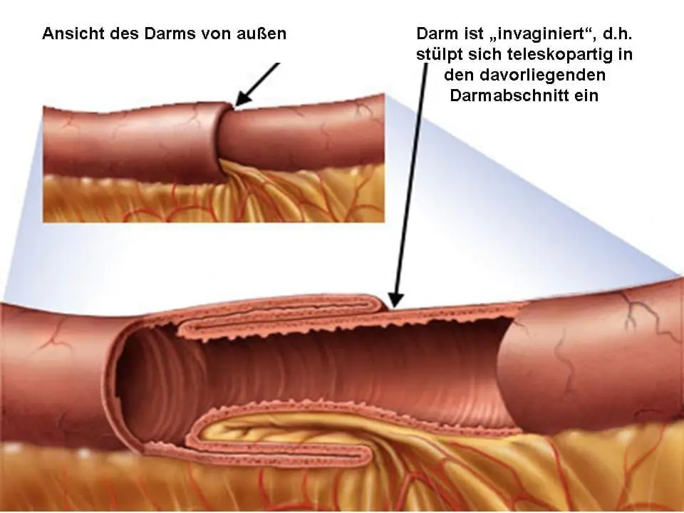 Intussusception