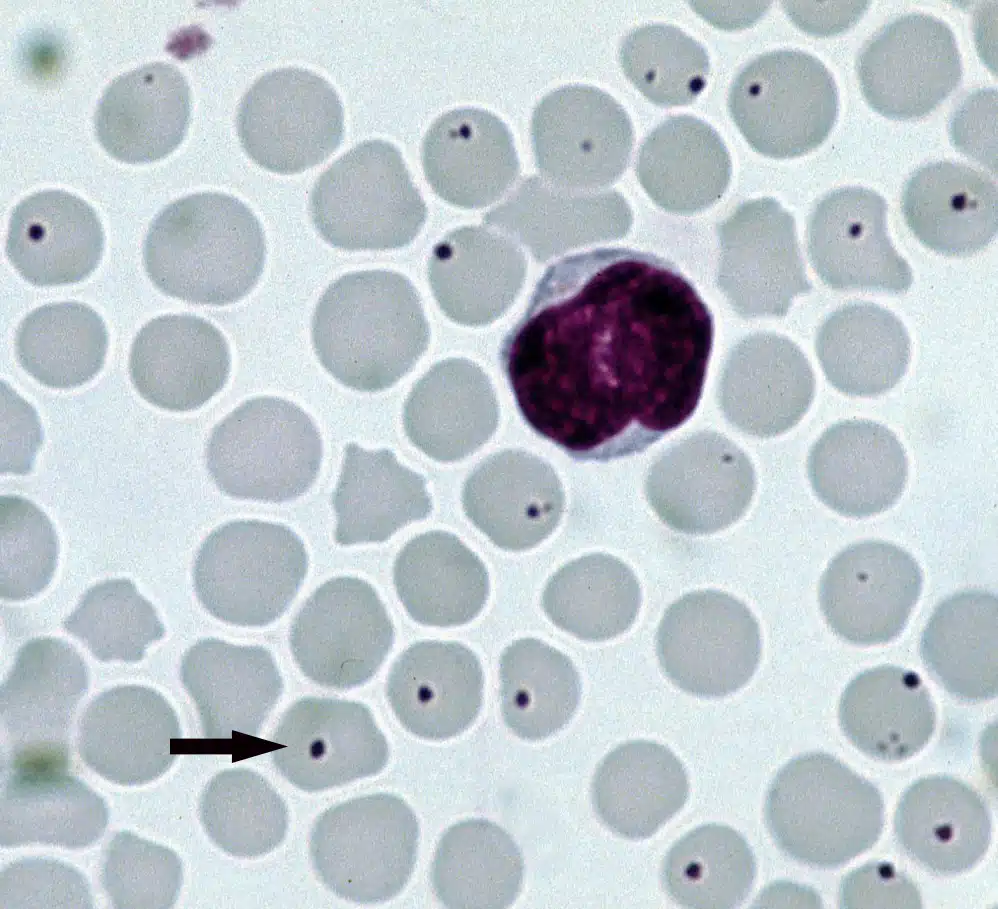 Anaplasmosis