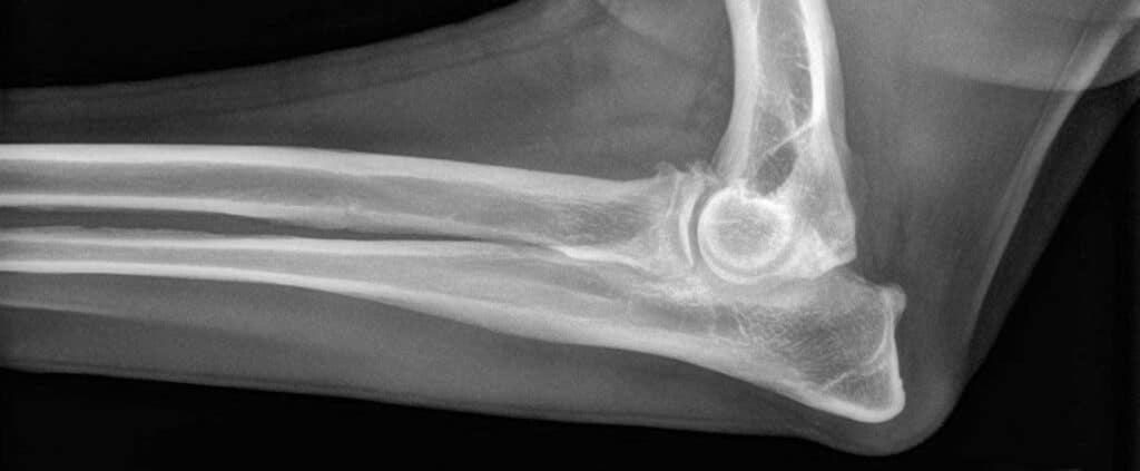 Elbow dysplasia in dogs