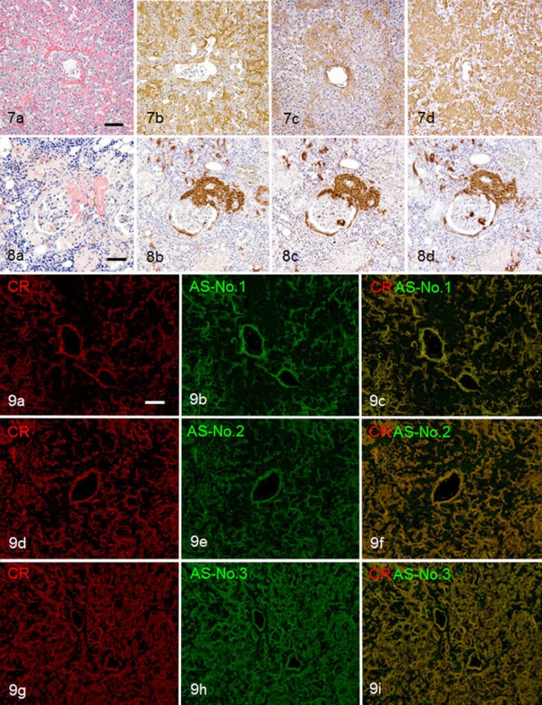 Amyloidosis a Kazen