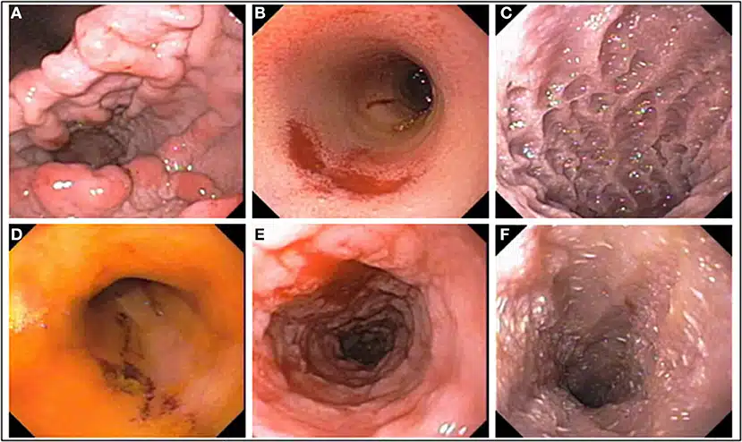 chronic enteropathy in dogs