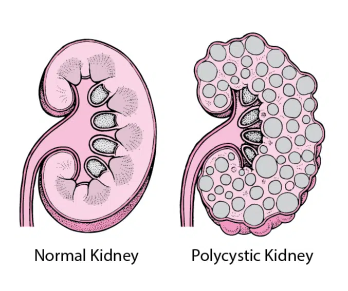 Polycystic kidney disease in cats