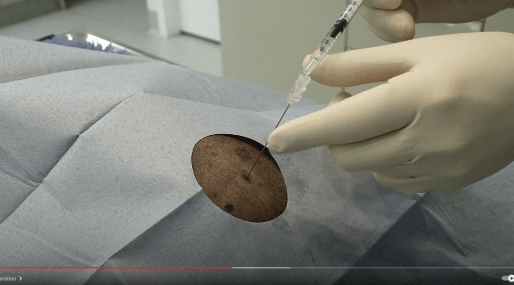 Epidural anesthesia for TPLO